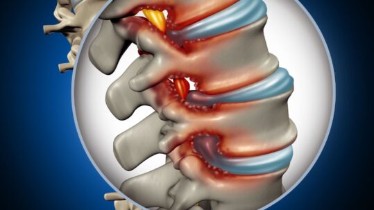 Spinal Stenosis Medical Concept