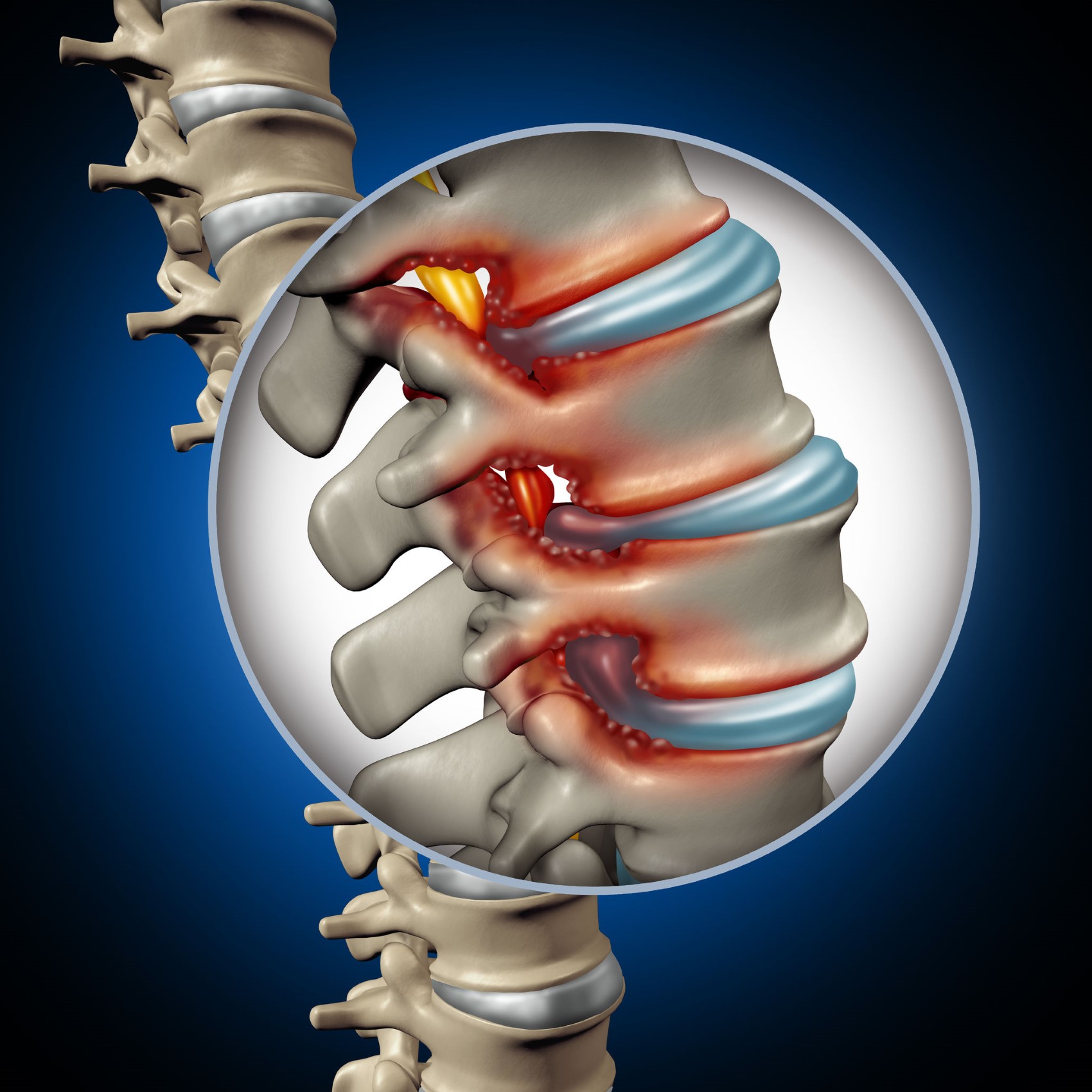 Spinal Stenosis Medical Concept