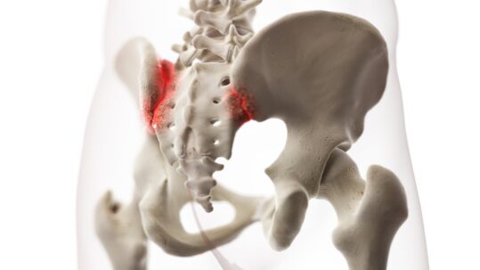 3d rendered medically accurate illustration of an arthritic iliosacral joint - Sacroiliac Joint Dysfunction