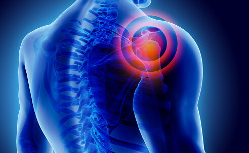 rotator cuff tendinopathy shoulder pain