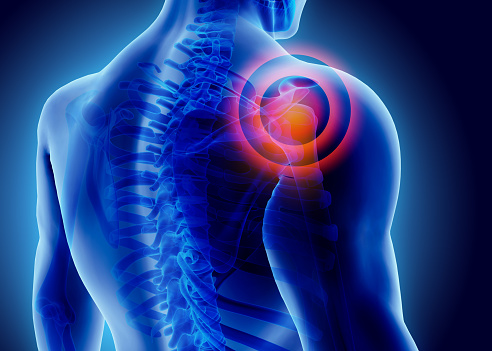 rotator cuff tendinopathy shoulder pain